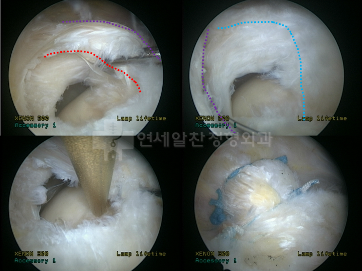 회전근개 복잡파열(점액낭측 인대 일부 보존상태)에서 봉합나사못을 이용한 해부학적 봉합술의 결과