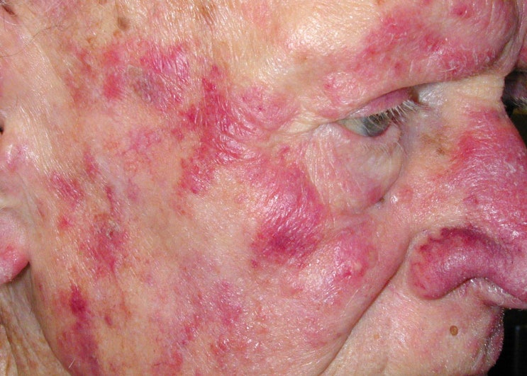 피부백혈병, Leukemia cutis, 백혈진 (Leukemid), 백혈병 치료도중 호중구 에크린땀샘염이 발생할 수 있는데 ...
