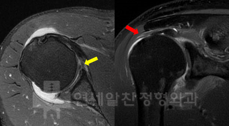 회전근개 광범위 파열 과 반카르트 병변이 동반된 경우 반카르트 봉합술 및 이열교량형 봉합법을 이용한 회전근개 봉합의 결과