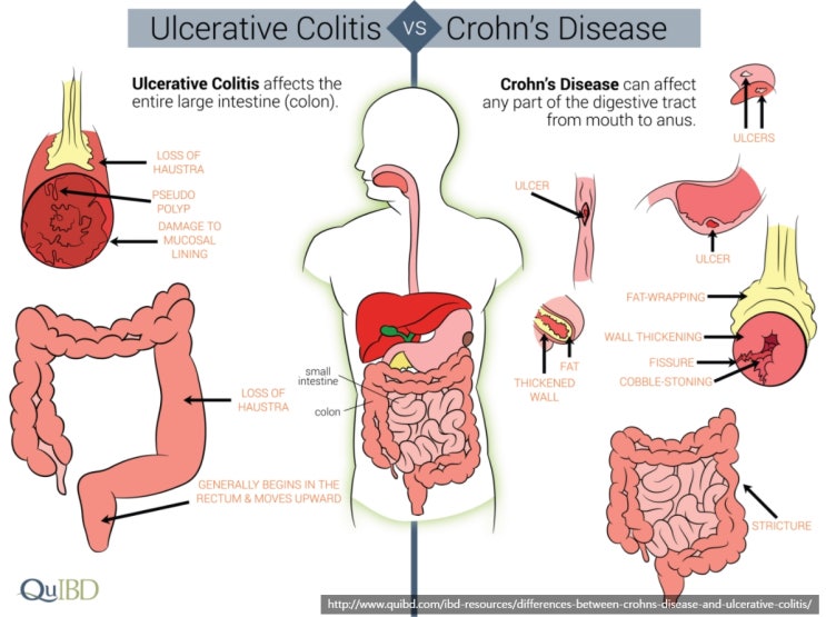 크론병과 궤양성 대장염 차이, Difference between Crohn’s disease and ulcerative ...