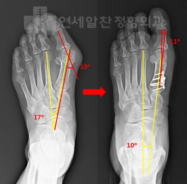 무지외반증에서 근위절골술을 이용한 교정절골술의 결과