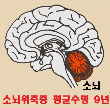 소뇌위축증의 평균 수명 : 네이버 블로그