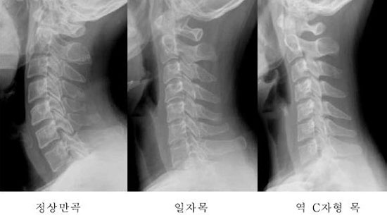 일자목, 거북목의 차이점 - 교정해야 하는 이유 : 네이버 블로그