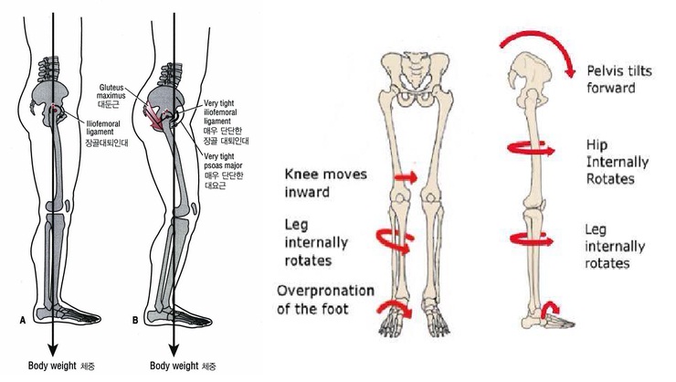 고관절 외회전 증후군 Hip Lateral Rotation Syndrome 네이버 블로그