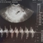 임신 초기 : 심장소리 듣고 입덧의 시작!