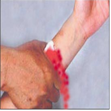 여러 원인에 따른 출혈과 지혈 방법 How to stop bleeding in various situations : 네이버 블로그