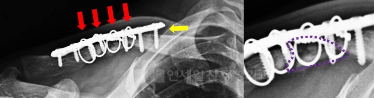 쇄골 골절 후 불유합으로 인한 재수술 및 실패 요인에 대한 생각