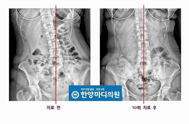 요추 교정사례 (측만, 일자허리) - 한양마디의원 : 네이버 블로그