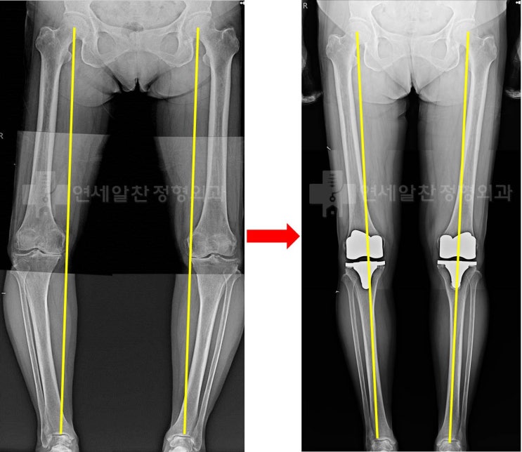 무릎 퇴행성 관절염에서 인공관절 전치환술 및 결과에 대한 고찰