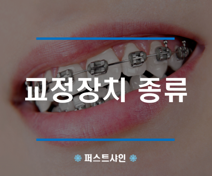 [교정] 치아 교정장치 종류와 선택 