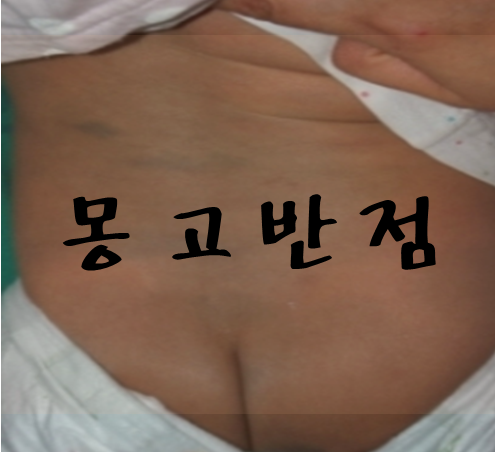 몽고반점 Mongolian spot (피부과전문의) - 우리 아이 몽고반점 없어질까? 경과와 치료에 대해. : 네이버 블로그