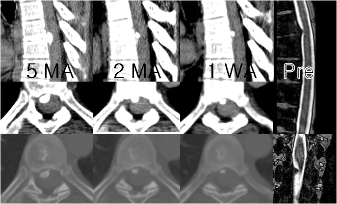 Shrinkage of very high intensity HTD on CT scan GWH : 네이버 블로그