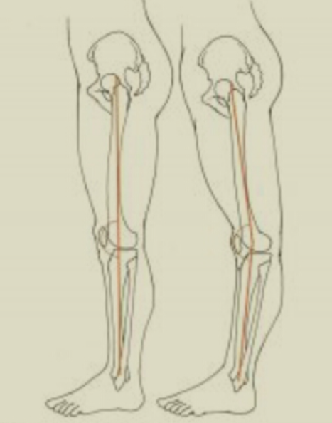 반장슬 (back knee, 젖힌무릎, genu recurvatum) : 네이버 블로그