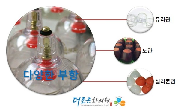 [부항치료 시흥 정왕동_더조은한의원]부항치료는 어디에 좋나요?/시화한의원/안산한의원/부항/습부항/건부항/피빼는 부항 술 마시면 ...