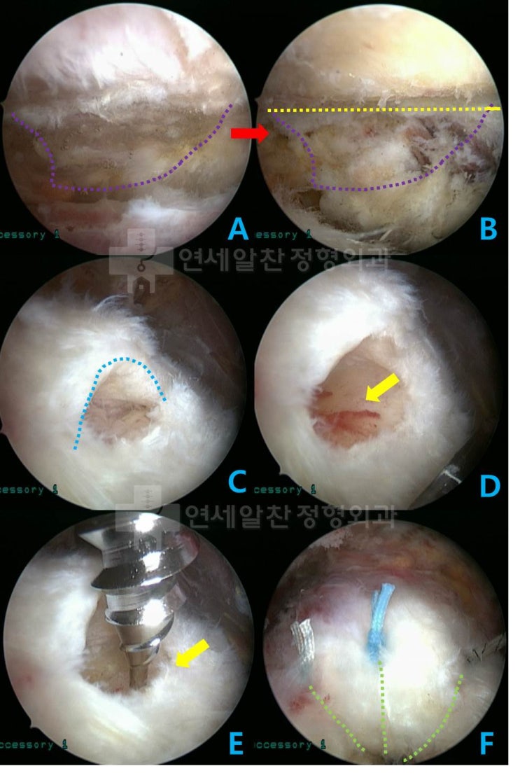 극상근 점액낭측 파열, 충돌증후군에서 극상근 봉합술 및 견봉성형술