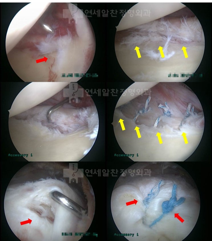 외상으로 인한 방카르트 병변 및 극상근 점액낭측 파열에서 방카르트 및 극상근 봉합술