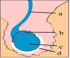 고환염 Orchitis : 네이버 블로그