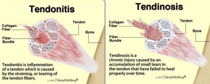 [논현 학동 필라테스] 이제는 구분하자, 건 염증? tendinitis ? tendinosis ? : 네이버 블로그