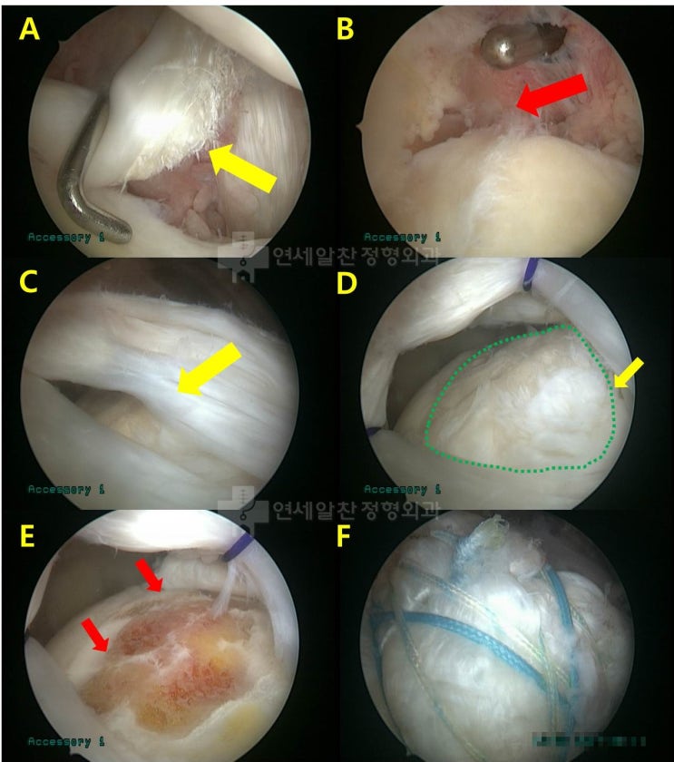 극상근 전층파열에 가까운 관절내측 파열에서 이열교량형 봉합법을 이용한 복원 및 원인에 대한 고찰