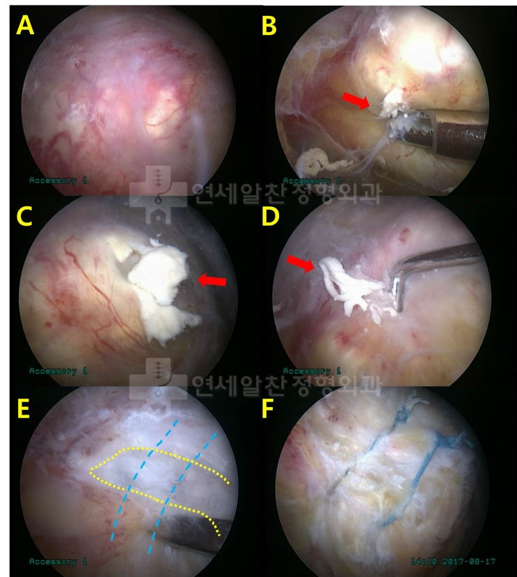 거대한 석회성 건염에서 관절경을 통한 석회 제거술 및 극상근 봉합술(side to side)