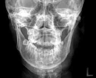 Mandible ap : 네이버 블로그