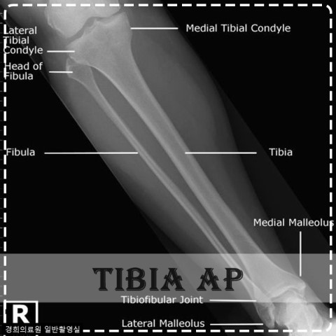 Tibia AP : 네이버 블로그