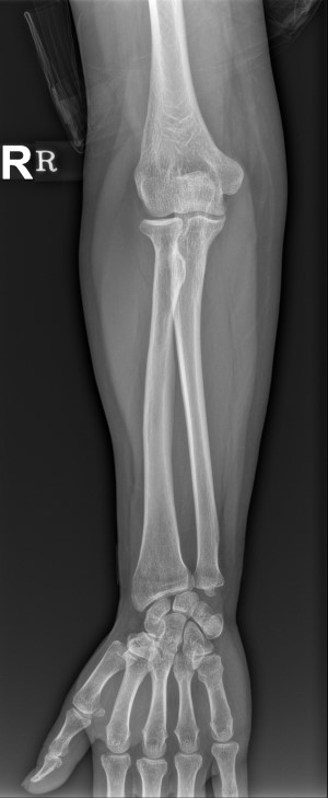 Forearm AP : 네이버 블로그