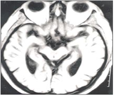 뇌종양 Brain tumor : 네이버 블로그