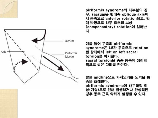 Piriformis Syndrome —, Naas Osteopaths