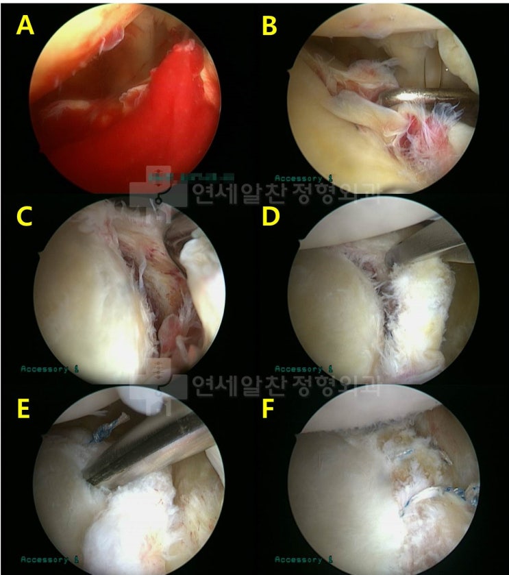 반카르트 병변에서 반카르트 봉합술에 대한 고찰
