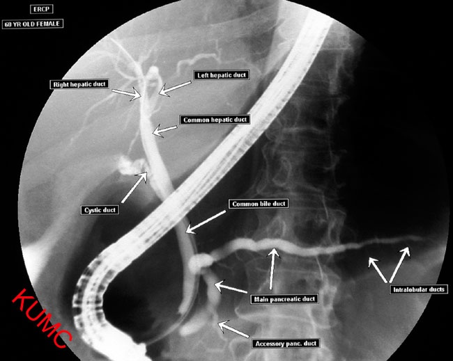 ERCP(내시경적 역행성 담췌관 조영술) : 네이버 블로그