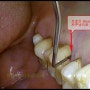 치은열구와 치주낭 <잇몸염증 잇몸치료 제대로 알기 4.>