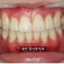 치열이 고르지 않은 치아교정