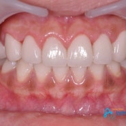 양재역치과 치아성형] 짧은 치아의 변신! 잇몸성형으로 환한 미소를 지어보아요!