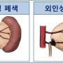 [소아비뇨기과] 신우요관이행부협착증의 원인