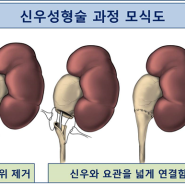 [소아비뇨기과] 신우요관이행부협착증의 치료