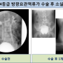 [소아비뇨기과] 방광요관역류의 수술 결과와 수술 반흔