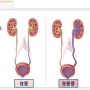 [소아비뇨기과] 방광요관역류의 정의