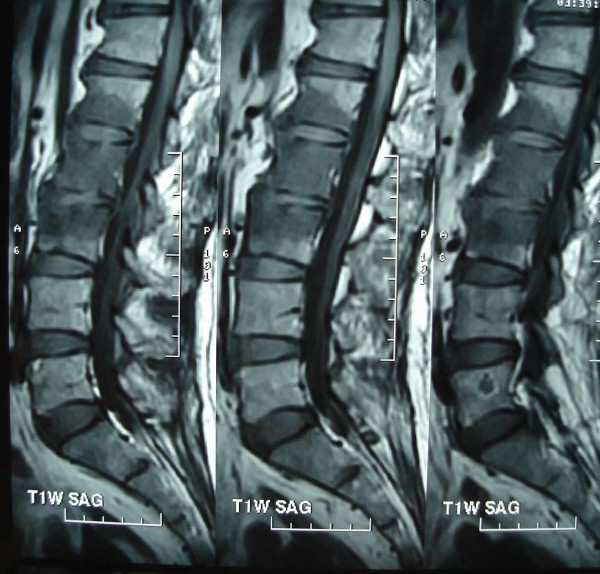 [추간판염] 디스크에 염증이? 통증이 심해지고 열/오한/이 있어요! 대소변에 장애가 발생해요! - Discitis : 네이버 블로그