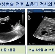 [소아비뇨기과] 신우요관이행부협착증의 추적관찰 및 수술흉터