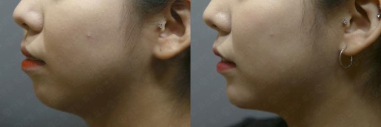 턱끝필러, 자갈턱보톡스 : 네이버 블로그