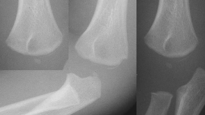 상완골 원위 골단판 골절(Transphyseal distal humerus fracture) : 아동 학대를 당한 유아에서 ...