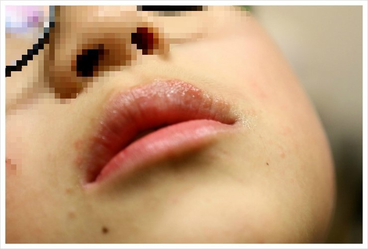 입술 포진 헤르페스 물집 생겼다면 원인은? : 네이버 블로그