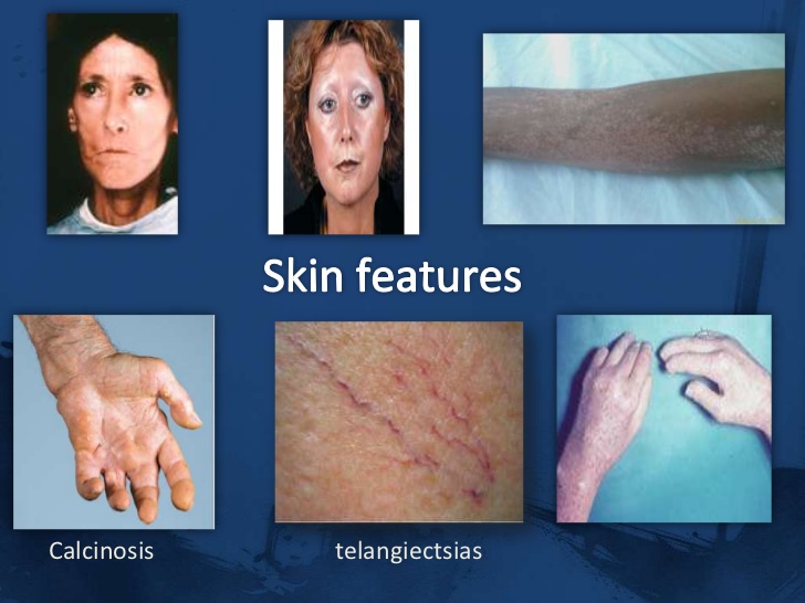  systemic sclerosis ssc raynaud s