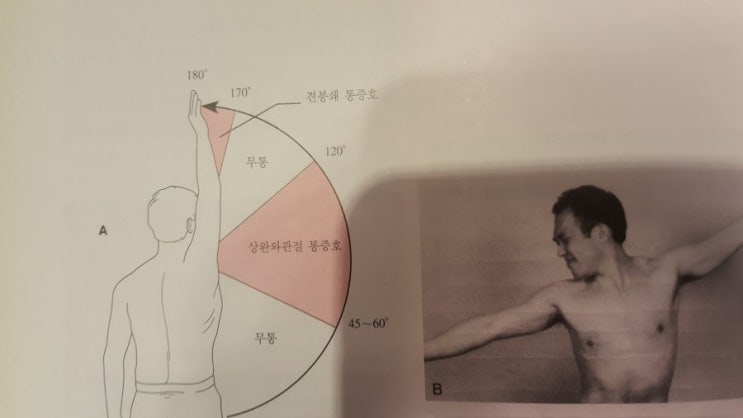 견관절의 통증호 : 네이버 블로그