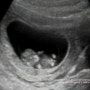 [태교일기_9w+2d] 임산부 초기검사, 보건소 초기 임산부 검사, 젤리곰 태아