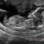 [태교일기_12w] 1차 기형아 검사, 임신 12주 태아성별, 임산부 비타민D, 임산부 코피