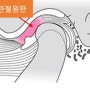 [턱관절 장애] 턱관절 장애의 분류 / 인천 구월동 턱관절