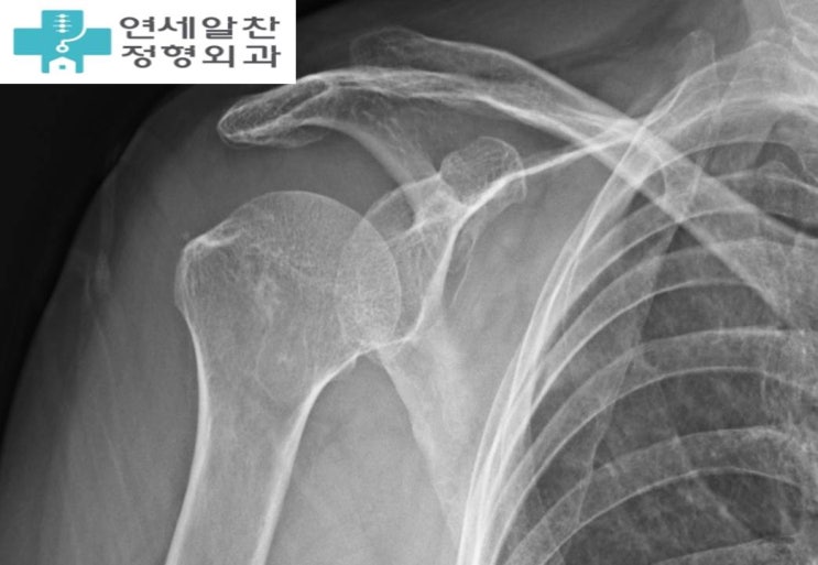 Supraspinatus Repair and Biceps Tenotomy for Supraspinatus Tear with Long Head of Biceps Tear