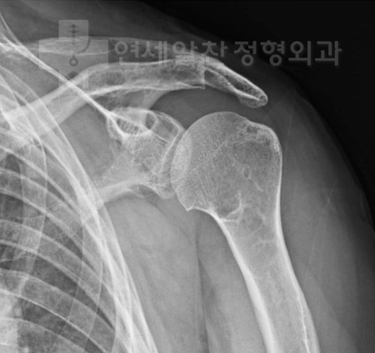어깨 퇴행성 관절염을 동반한 회전근개파열에서 연골 연마관절성형술(abrasion arthroplasty) 및 회전근개 봉합술
